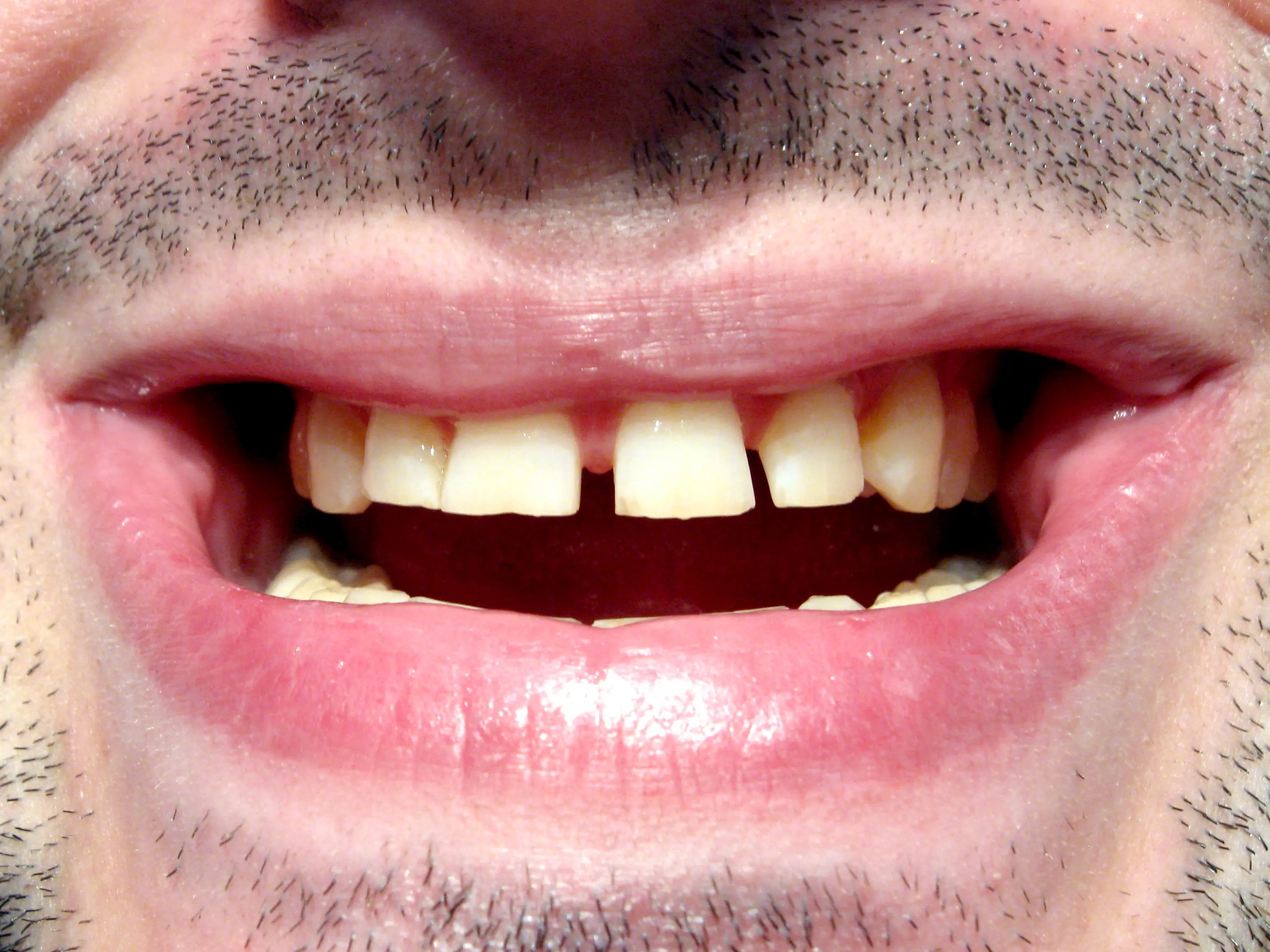 Your Lips To Google's Ears: Voice Typing On Google Docs